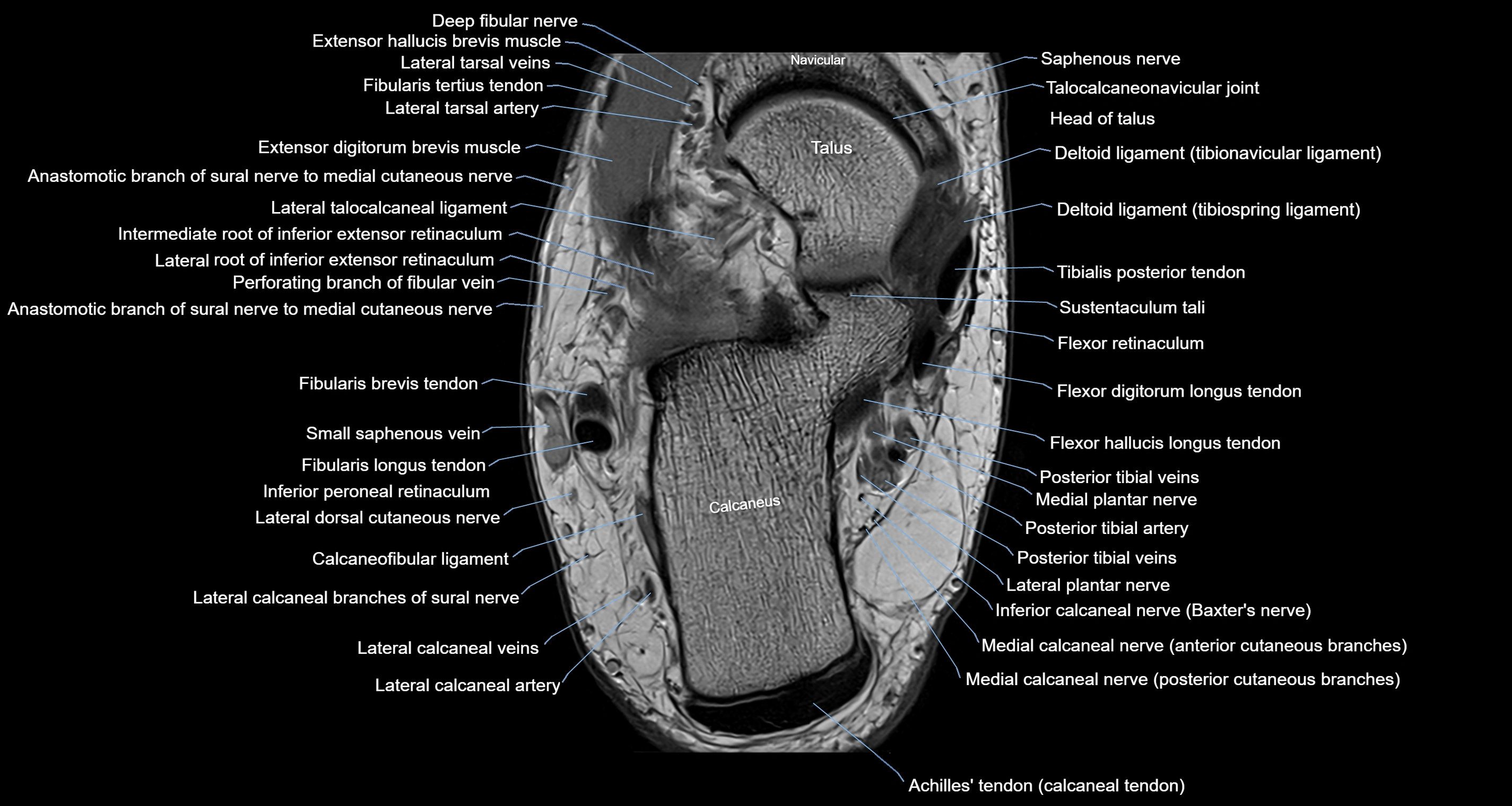 Ankle axial anatomy 3T MRI images -img-10001-00025.webp